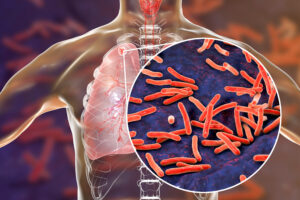 3D screening of human with tuberculosis in lungs